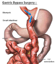 Gastric Bypass