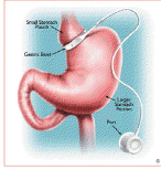 Lap Band Surgery